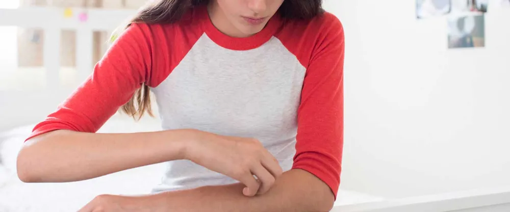 Kurdeşen (Ürtiker) Nedir? Belirti ve Tedavi Yöntemleri Nelerdir?